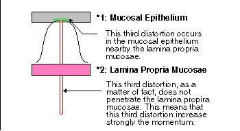esophageal cancer